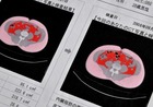 メタボ関連治療費を3割削減! 医療費危機の打開策とは?