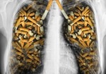 死よりも恐ろしい病気「COPD」がタバコの警告文にも登場