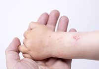 乳酸菌で「アトピー性皮膚炎」が改善〜アレルギー予防には“小腸の免疫アップ”