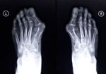 外反母趾も巻き爪も足の構造異常。歪みを治すことで根治も可能