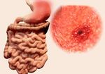乳酸菌は「胃がん」の最大の原因であるピロリ菌の除去にも効果を発揮!