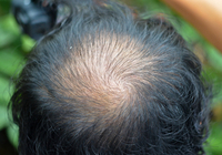「脱毛」の真の原因は「免疫細胞」の異常だった！　円形脱毛症の治療にも光明が