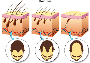 AGA治療はコスパが重要～薄毛の悩みを抱える人は1200万人　