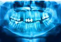 閉経後の「歯周病」は発がんのリスクに～歯周病菌が全身の炎症を起こす！？