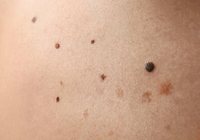 ほくろに悪性の皮膚がんメラノーマ（悪性黒色腫）が発生する可能性は意外に低い