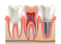 歯の神経の治療とは？　「歯内療法」や「根管治療」は痛みや腐敗を除去する重要な治療