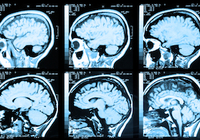 脳ドックで脳動脈瘤が見つかったらどうする　手術か経過観察かどちらが正しい？
