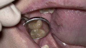 「顕微鏡歯科治療」とは何か？　見過ごされていた奥歯の虫歯を顕微鏡で発見の画像2