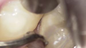 「顕微鏡歯科治療」とは何か？　見過ごされていた奥歯の虫歯を顕微鏡で発見の画像3