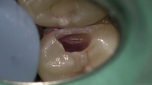 「顕微鏡歯科治療」とは何か？　見過ごされていた奥歯の虫歯を顕微鏡で発見の画像5