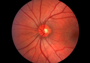 AI診断プログラムを米国食品医薬品局が初承認！ 眼底カメラの画像から糖尿病性網膜症を診断の画像1
