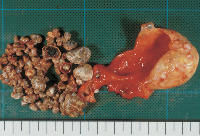 【閲覧注意】胆嚢炎のなれの果て？ 胆石で満ちた陶器のような胆嚢の画像2