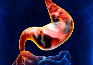 ピロリ除菌で使われる胃薬PPIで、実は胃がんリスクが上昇するという矛盾！　の画像1